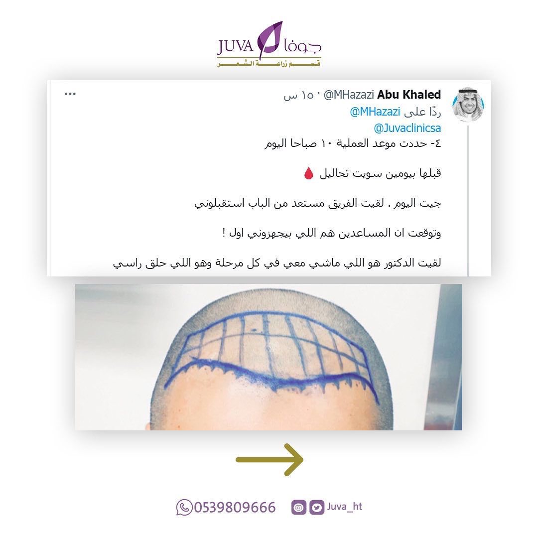 Juva_ht's tweet photo. للإستفسار يُرجى التواصل معنا عبر أرقام الإتصال أو عبر الواتس أب 🌺

📍الرياض ، شارع التخصصي
0114809666 أو 0539809666

#الرياض #زراعة_الشعر_في_تركيا #زراعة #زراعةالشعر #زراعة_الشعر_في_اسطنبول #زراعة_الشعر https://t.co/e4ctH1PVtR