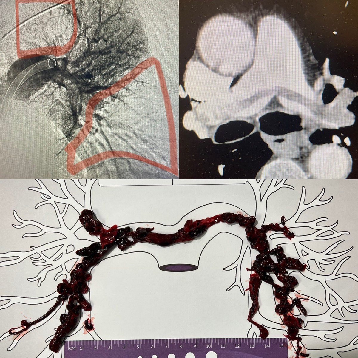 RexRayMD's tweet photo. Massive saddle PE, transfer from OSH. HR 130s, SBP 80s-90s, troponin 541, D-dimer 11,582. SO MUCH CLOT!! #IRad @InariMedical Patient did great, discharged POD#2 https://t.co/VKlOUgVQBt