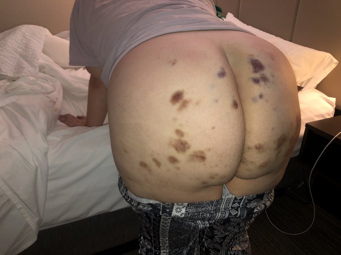 Bruise watch 2k22 🥰 @fetishcon https://t.co/QPlasBxKxf<a class="tags" href="/tag/fetishcon">@fetishcon</a><a href="/tag/mvsales"class="tags"><span>#mvsales</span></a>