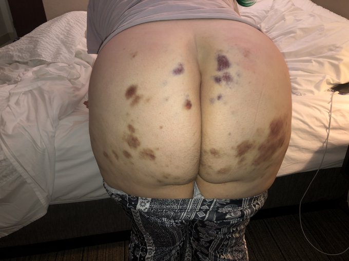 Bruise watch 2k22 🥰 @fetishcon https://t.co/QPlasBxKxf<a class="tags" href="/tag/fetishcon">@fetishcon</a><a href="/tag/mvsales"class="tags"><span>#mvsales</span></a>