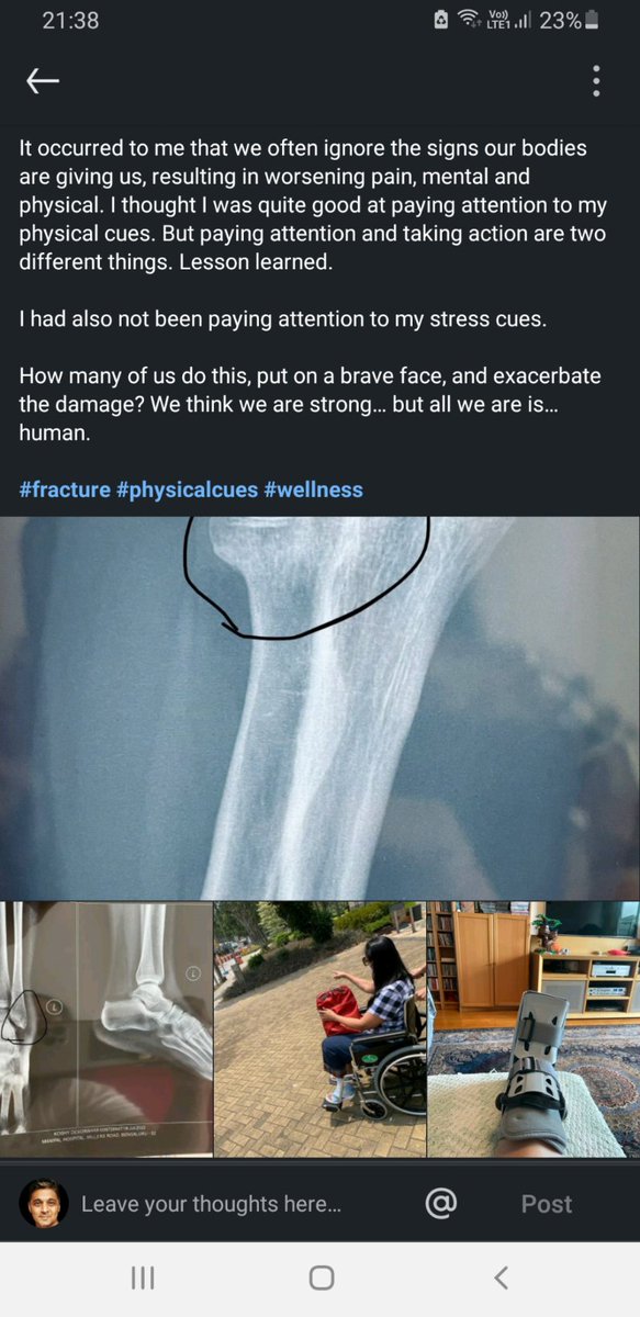 Skyvallker's tweet photo. You fracture your leg and its a LinkedIn post!! So many life lessons in this #stateoflinkedin #linkedin https://t.co/xBQWqW3YSp