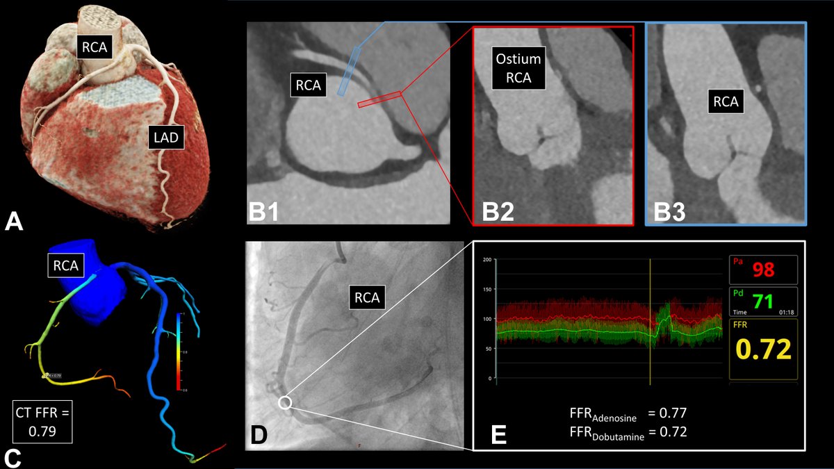 JACCJournals's tweet photo. Discover the value of #yesCCT #FFR for the noninvasive assessment of hemodynamic relevance in patients with #ACAOS before and after surgical treatment. https://t.co/Xl48Xu2XPY
#JACCCaseReports #CardioTwitter @biglermarius @andgiannopmd @MatthiasSiepe @RaberLorenz @chrisgraeni https://t.co/LubyGbk6xx