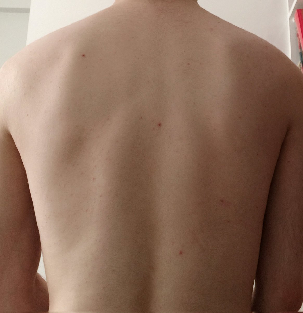 3 ay sonra before after yapcam😁