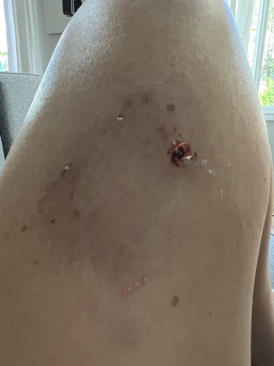 SerenaCMah's tweet photo. PLEASE keep you dogs on a leash. This is the second time a dog off leash in our neighbourhood has charged after me and mine. This time I got bit.  #sweetgus is ok I’m battered and bruised. #dogsoftwitter #yeg https://t.co/dfr8rU06fJ