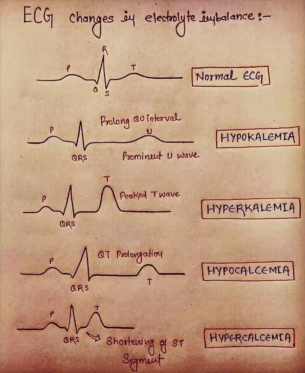 AldecoBravo's tweet photo. Cambios electrocardiográficos https://t.co/teEirGCIt1
