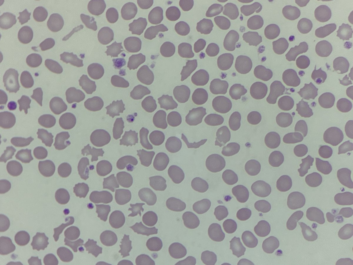 BloodScientist's tweet photo. #MorphologyMonday

These images are from a patient with fatal chronic heart failure. What are some of the stand-out features you can see in the blood film and what else may be going on?

#underthescope #onlycells https://t.co/SHhZouK8Gs