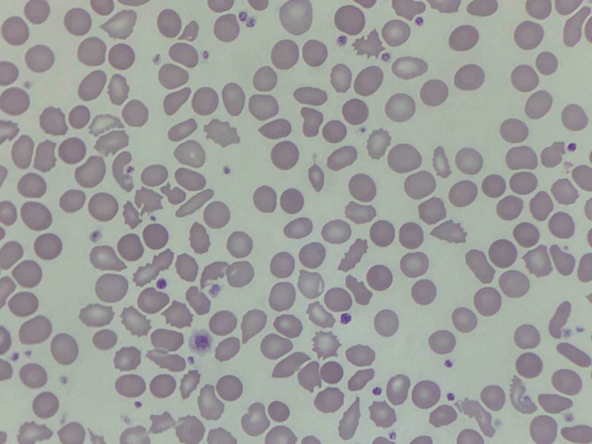 BloodScientist's tweet photo. #MorphologyMonday

These images are from a patient with fatal chronic heart failure. What are some of the stand-out features you can see in the blood film and what else may be going on?

#underthescope #onlycells https://t.co/SHhZouK8Gs