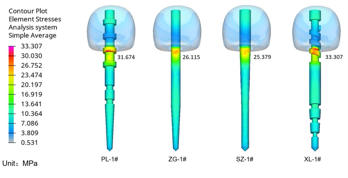 Aria112244's tweet image. The fiber post process gives it maximum stress and anti-fracture strength under normal occlusion conditions.
Use longer
Fewer fractures 
Lower return rate
#fiberpost #dentalsupplies #dentalcare #dental #postcorecrown
📱+86 18948987800