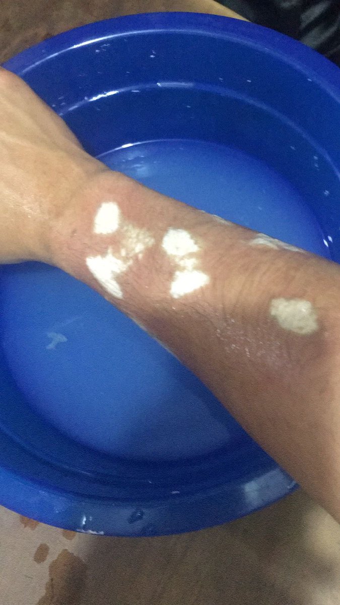 Me queme el brazo quien me aconseja algo