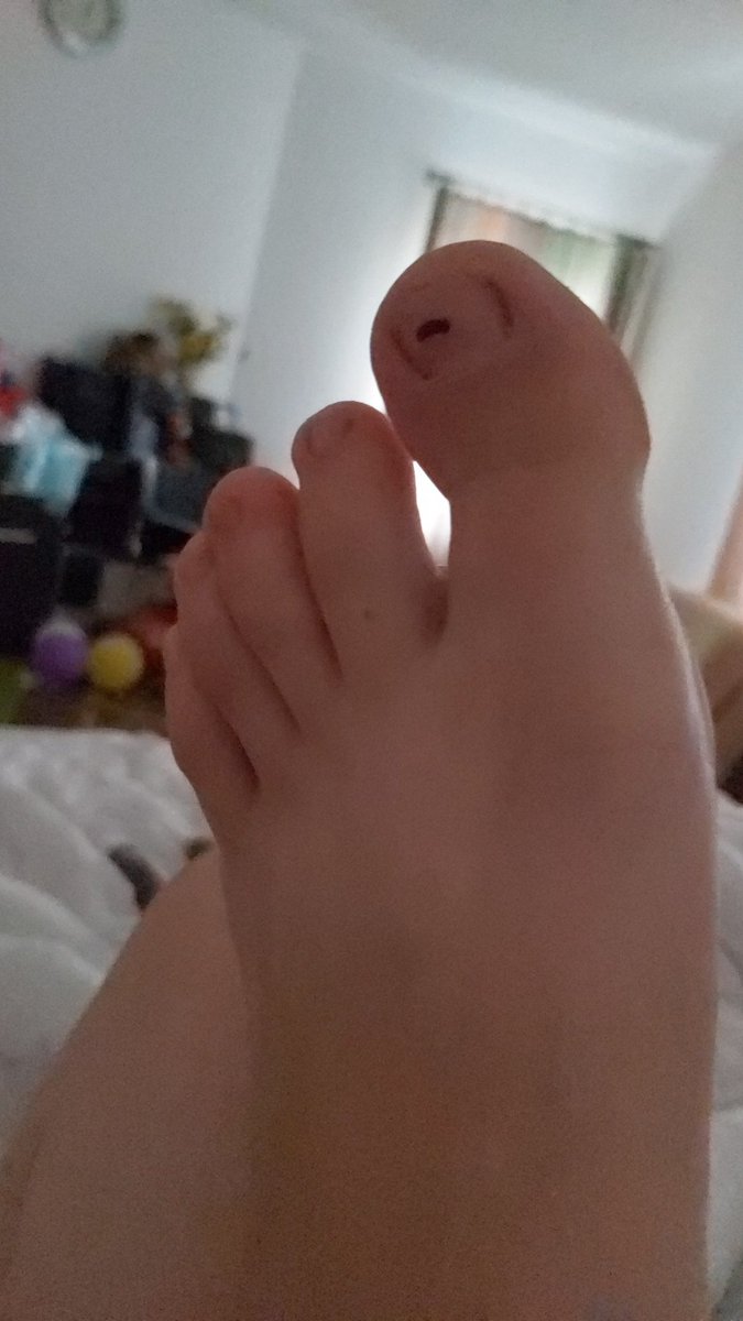 MSAndie94's tweet photo. Here's a reminder about how long it takes for an undernail black spot to go away. It's still there 😆 it was at the base of my toe. https://t.co/ijmBGG7kHI