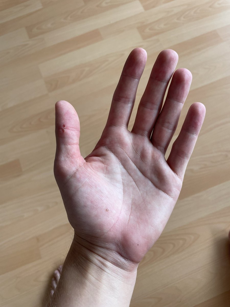 gabelserik's tweet photo. wieder mal ein beeindruckendes beispiel wieso ich nur jedem raten kann mit handschuhen zu fahren eine offene hand könnte ich jetzt zum offenen bein echt nicht gebrauchen https://t.co/a6Wyvrry0k