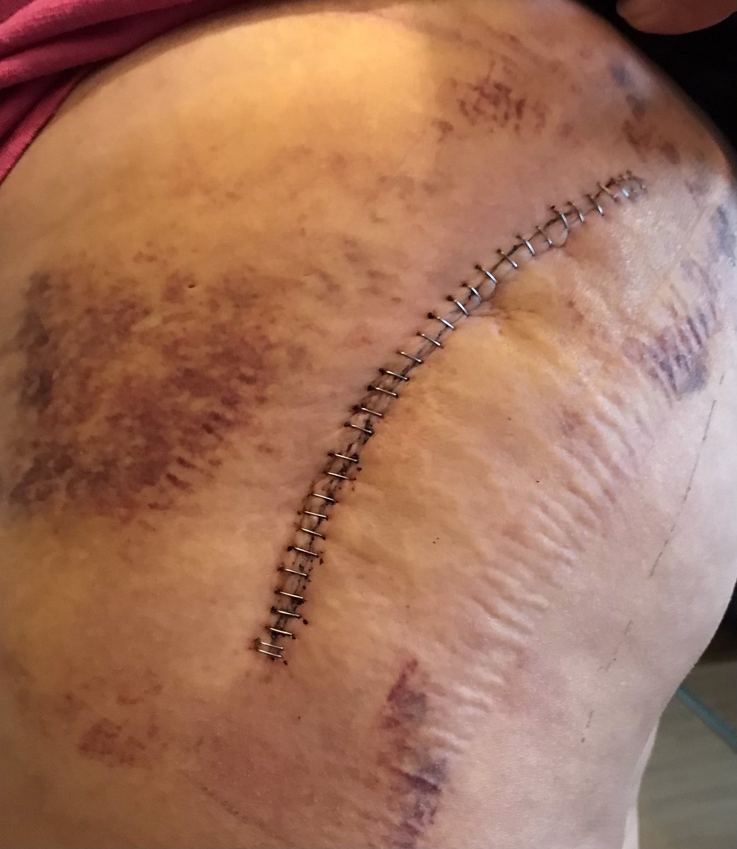 FrauQuagner's tweet photo. Neues von der Front:
Tag 10 Post-OP und ich finde langsam gehts. Wenn jetzt noch die Schwellung und die Verhärtungen iwann mal weggehen bin ich zufrieden. 😊💪🏻👍
#hüfttep #hüftop #narbe #hüftprothese https://t.co/eeRVCYVmir