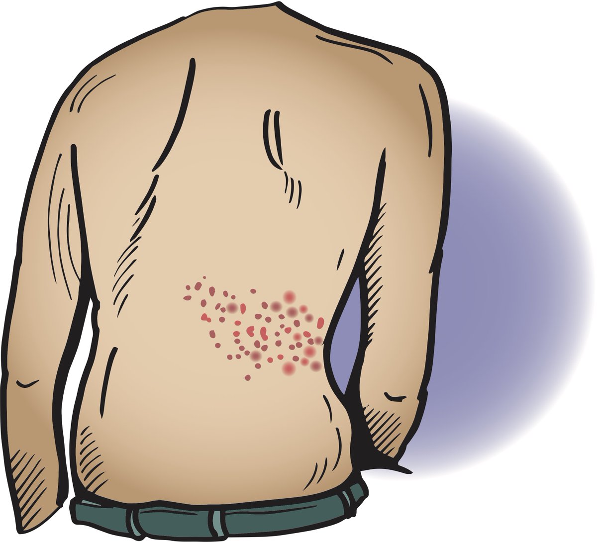 GP feedback on our #shingles study: "We can fully recommend the Athena study as a straightforward study to do and patients seem very keen to be involved" Over 50 GP surgery groups across England are recruiting patients &gt;=50 years with new shingles rash athena-study.bristol.ac.uk/gp-surgeries/