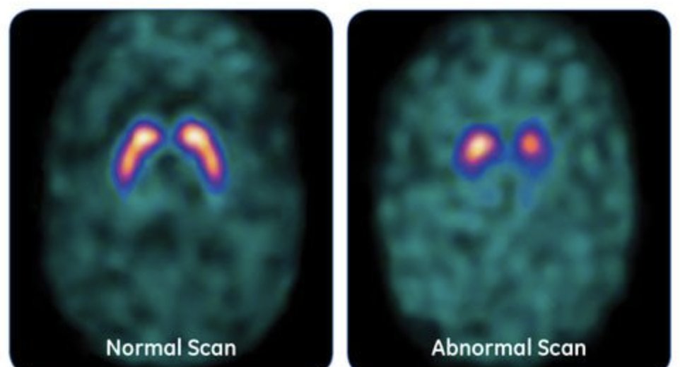 Your health care team should never tell you, 'your DAT scan shows you have Parkinson's disease.' The message is that there is an abnormality in the dopamine transporter system which can suggest Parkinson's or other diseases. This 'list' is growing of diseases with abnormal DAT.