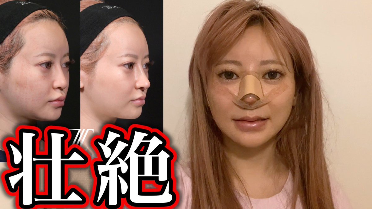さおり ん 整形