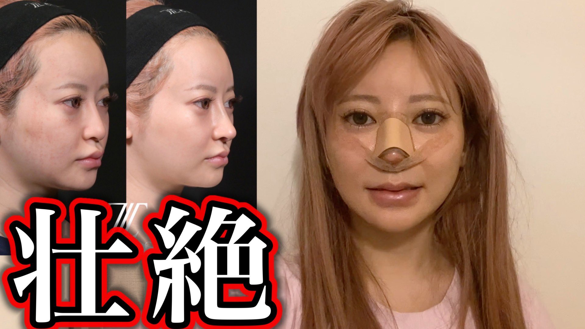 さおり ん 整形