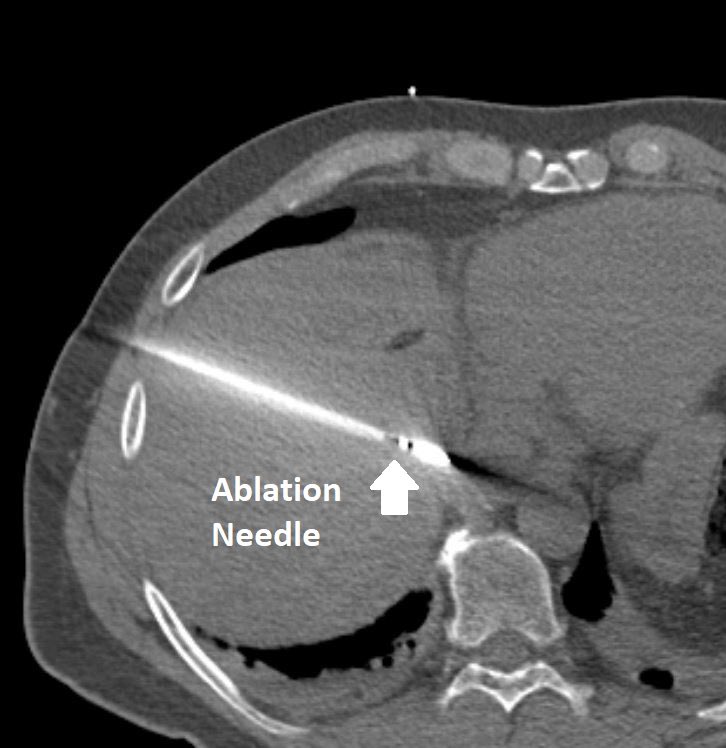 Image-guided ablation by interventional radiology (#IRad), where a thin needle placed through the skin burns the #cancer to death, has similar outcomes to surgery for select patients with liver cancer. This outpatient procedure has fewer complications than #surgery.