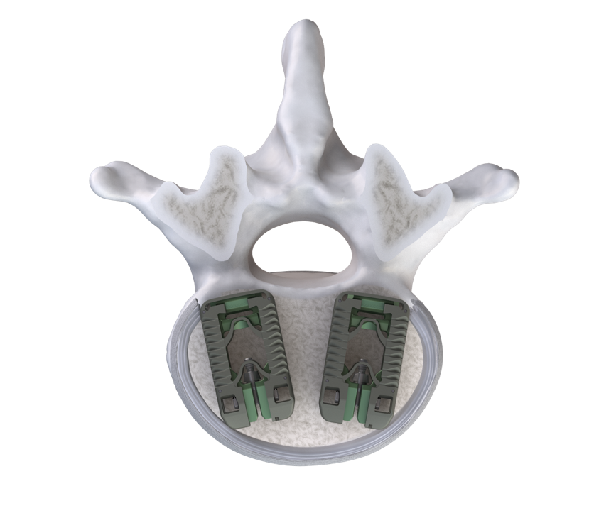 Accelus1's tweet photo. Accelus Announces First Surgeries Using FlareHawk® TiHawk11™ Interbody Fusion System. Read the full press release at https://t.co/WmsbBqMAJN. #FlareHawk #TiHawk #AdaptiveGeometry #AccessWithoutCompromise #SpineSurgery https://t.co/TPQdENnujN