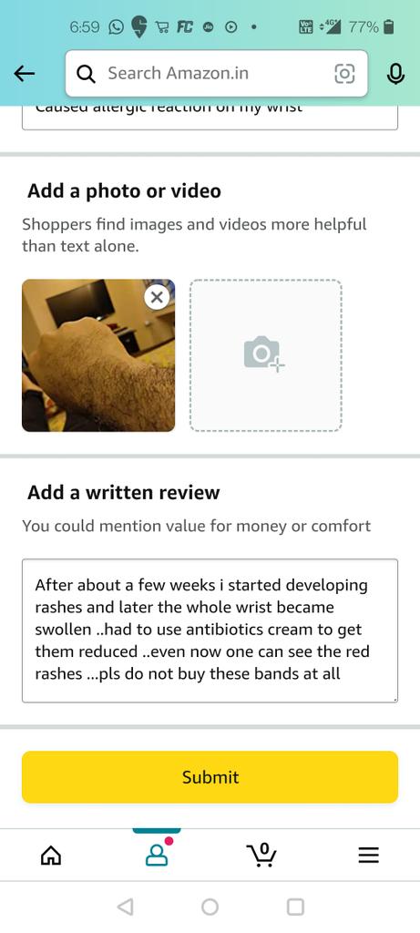 gaurav999anand's tweet photo. @amazonIN sent a band which caused allergy all over my wrists ..called cust service and was assured refund. now refusing to refund as they say it's over the time threshold not understanding that the allergic reaction came over that time and costed me medical extra https://t.co/GlUyamKfbi