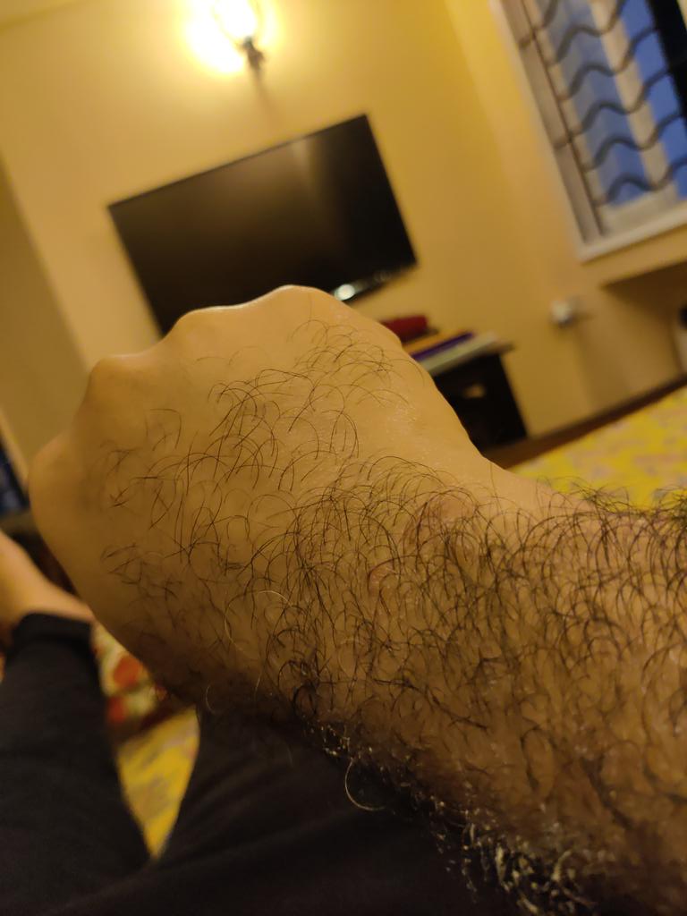 gaurav999anand's tweet photo. @amazonIN sent a band which caused allergy all over my wrists ..called cust service and was assured refund. now refusing to refund as they say it's over the time threshold not understanding that the allergic reaction came over that time and costed me medical extra https://t.co/GlUyamKfbi