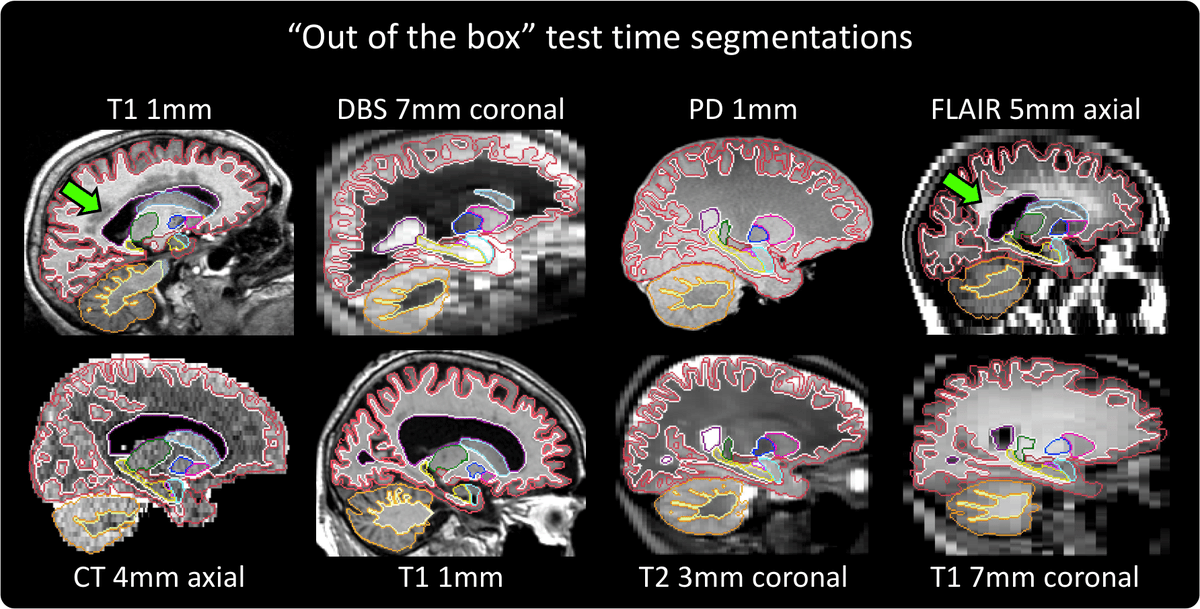 JuanEugenioIgl1's tweet photo. SynthSeg 2.0 is available on the new @FreeSurferMRI 7.3. Segment clinical brain MRI of any resolution and contrast, now with: 1. cortical parcellation; 2. estimation of intracranial volume; and 3. automatic quality control to know when it has failed.
https://t.co/ob7x5oKwYy https://t.co/vfkQlnCJ5X