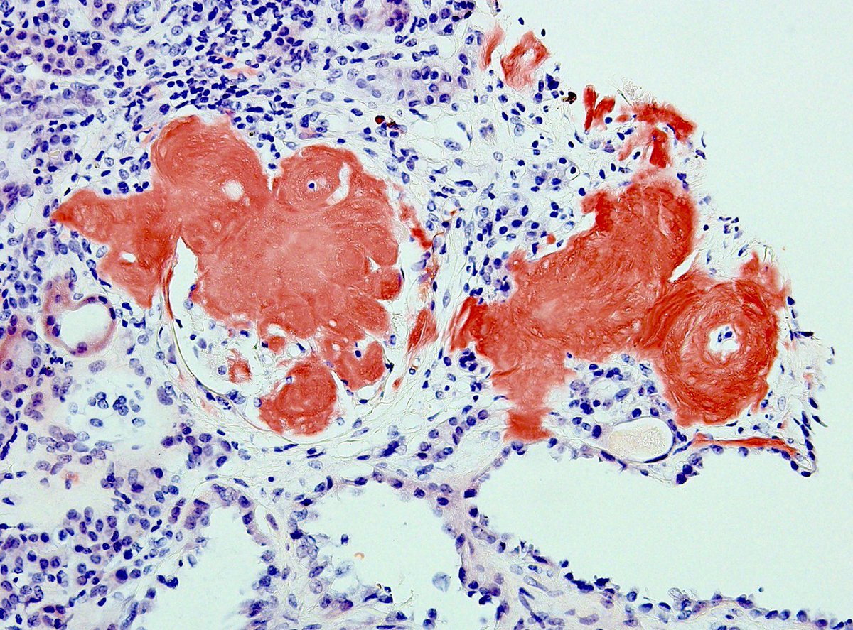 PathIsArt's tweet photo. This has to be without a doubt the best example of “apple green” birefringence of Congo Red-stained amyloid I have ever seen in real life. Note the dramatic deposition in the glomerulus, tubules and arteriole wall in this case of AA renal amyloidosis 🍏 #renalpath #PathTwitter https://t.co/idlMpL99Nm
