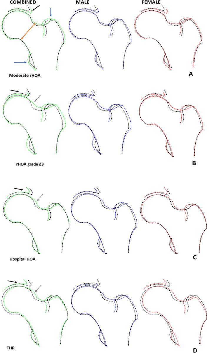 ASBMR (@asbmr) on Twitter photo New Accepted Article in #JBMR: Machine Learning–Derived Acetabular Dysplasia and Cam Morphology Are Features of Severe Hip Osteoarthritis: Findings From UK Biobank #ASBMR
<a href="/MonFrysz/">Monika Frysz</a> <a href="/JonTobias1/">Jon Tobias</a> <a href="/WileyHealth/">Wiley Clinical Health</a> <a href="/WileyBiomedical/">Wiley Biomedical Science</a>
ow.ly/iQWG50KhbB5 New Accepted Article in #JBMR: Machine Learning–Derived Acetabular Dysplasia and Cam Morphology Are Features of Severe Hip Osteoarthritis: Findings From UK Biobank #ASBMR
<a href="/MonFrysz/">Monika Frysz</a> <a href="/JonTobias1/">Jon Tobias</a> <a href="/WileyHealth/">Wiley Clinical Health</a> <a href="/WileyBiomedical/">Wiley Biomedical Science</a>
ow.ly/iQWG50KhbB5
