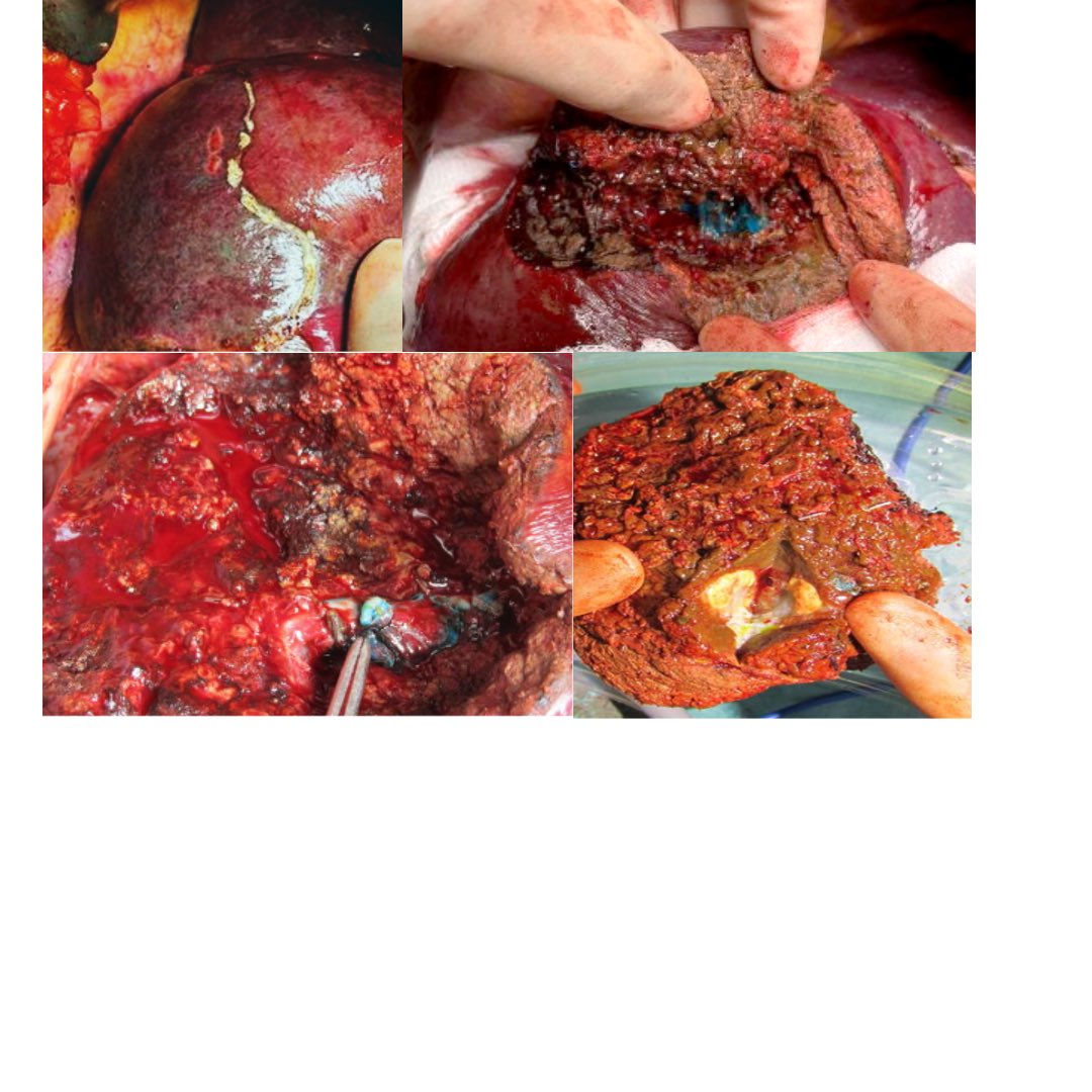 DasariVm's tweet photo. Ultrasound guided Transhepatic injection of dye to Seg 8 branch of portal vein for anatomical segment 8 resection, CRC metastasis with clear margins. Thanks to Cauinaud!! @EAHPBA⁩ @IHPBA @liver @liversurgery @hpb https://t.co/5NeJPXePHf