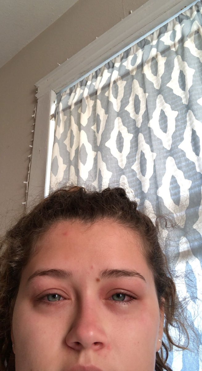 madisonslamb's tweet photo. 3 years ago today, I discovered I am allergic to peaches https://t.co/H2jOgQO1KN