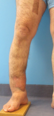 NEW Management of Complex Cases from HSS!

In Case 2, Austin T. Fragomen, MD (<a href="/SmyL_NY/">Austin Fragomen MD</a>), &amp; Stephen J. Wallace, MD, report on care of a 57-year-old man w/ infected, hypertrophic nonunion of the tibia  <a href="/LimbDeformity/">LLRS</a> #OrthoTwitter

hss.edu/conditions_com…