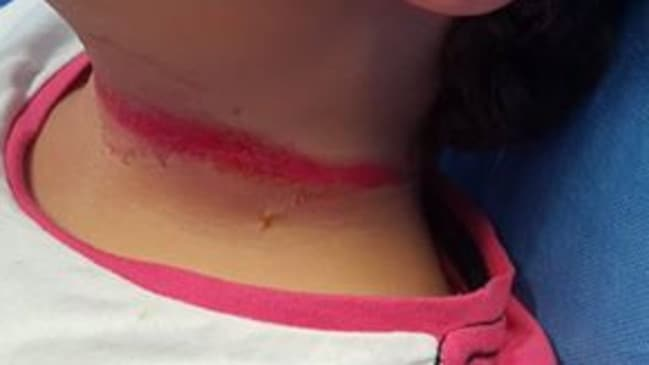 bagguley's tweet photo. @Cornpop_BadDude @FrizzellH @SpaceGator420 Yep. A rope across the neck is nasty. Even if there was only a 1% chance, that's still too much. This is what it can do. Would you be happy for your child to have this done to them? https://t.co/r9L4Y03YQ3