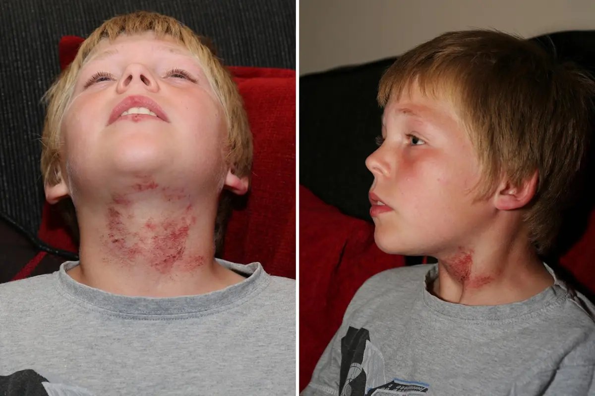 bagguley's tweet photo. @Cornpop_BadDude @FrizzellH @SpaceGator420 Yep. A rope across the neck is nasty. Even if there was only a 1% chance, that's still too much. This is what it can do. Would you be happy for your child to have this done to them? https://t.co/r9L4Y03YQ3