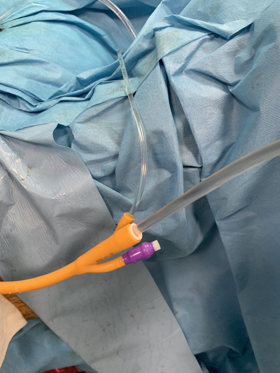 UrohealthClinic's tweet photo. 160 cc prostate… 22/19 Fr. instrument+100W Cyber Ho laser… Felt no big difference however TFL has obivous benefit for coagulation effect and it lowers the surgery time #thuflep #enbloc #earlyapicalrelease @FCAFigueiredo @fgomsan @quanta_system @micspin72 https://t.co/dmEbeKt7a6