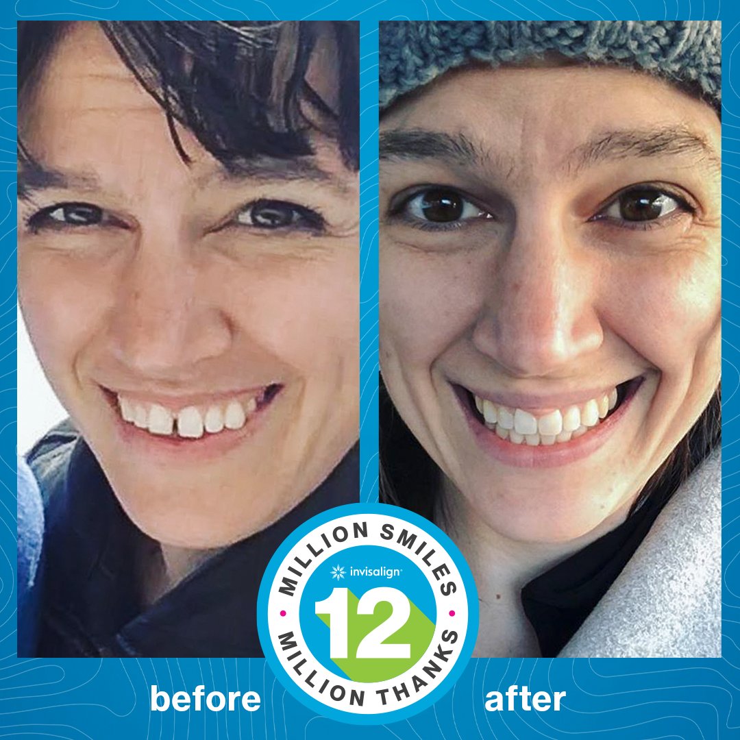 Invisalign's tweet photo. It wouldn't be #transformationtuesday without showcasing a beautiful new smile - this time starring graham.positive! 😊✨

#invisalign #invisalignsmile https://t.co/zVj0GyYYDm