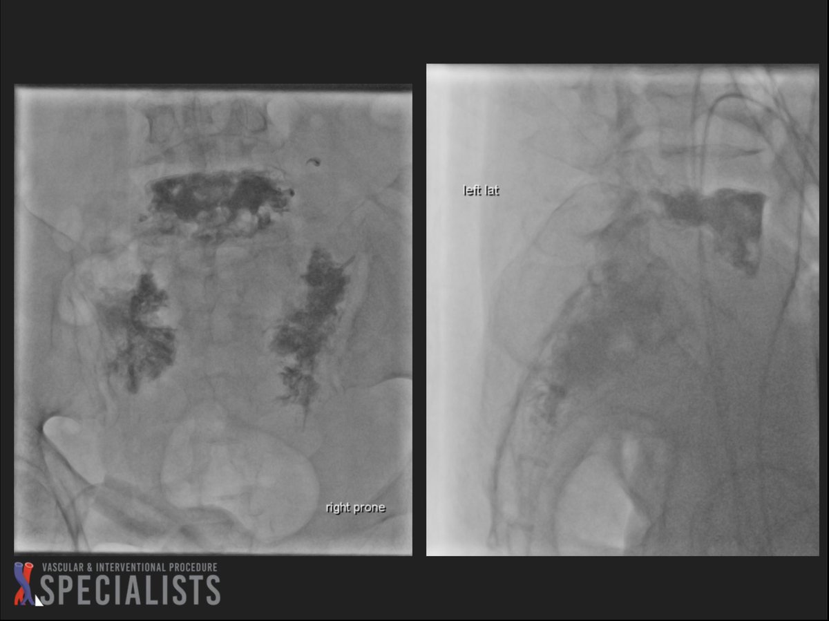 darthglader's tweet photo. Finally, the L5 #kyphoplasty with good balloon fill and good cement fill, with over 10 mL of cement in the vertebral body.

This is the new @Medtronic_Spine VuE bone cement - very easy to see. #FillGoals #MSKIR https://t.co/Bnvp1NwOIC