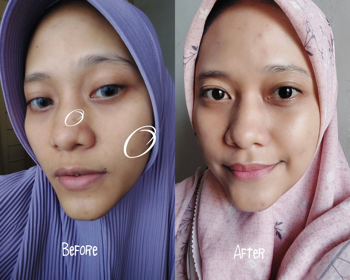 hayddengemz's tweet photo. Suka ga pede kalau kulit wajah bnyk bekas jerawat atau noda? Apalagi klo nodanya suka nangkring lama hilangnya. Manfaat dari kandungan serum ini bisa jadi salah satu pilihan tuk atasi noda wajah.
#racuninskincare #HayReview
✨️ AIRNDERM Serum Spot Lightening ✨️
-- A Review https://t.co/ZzS3aMpHTG