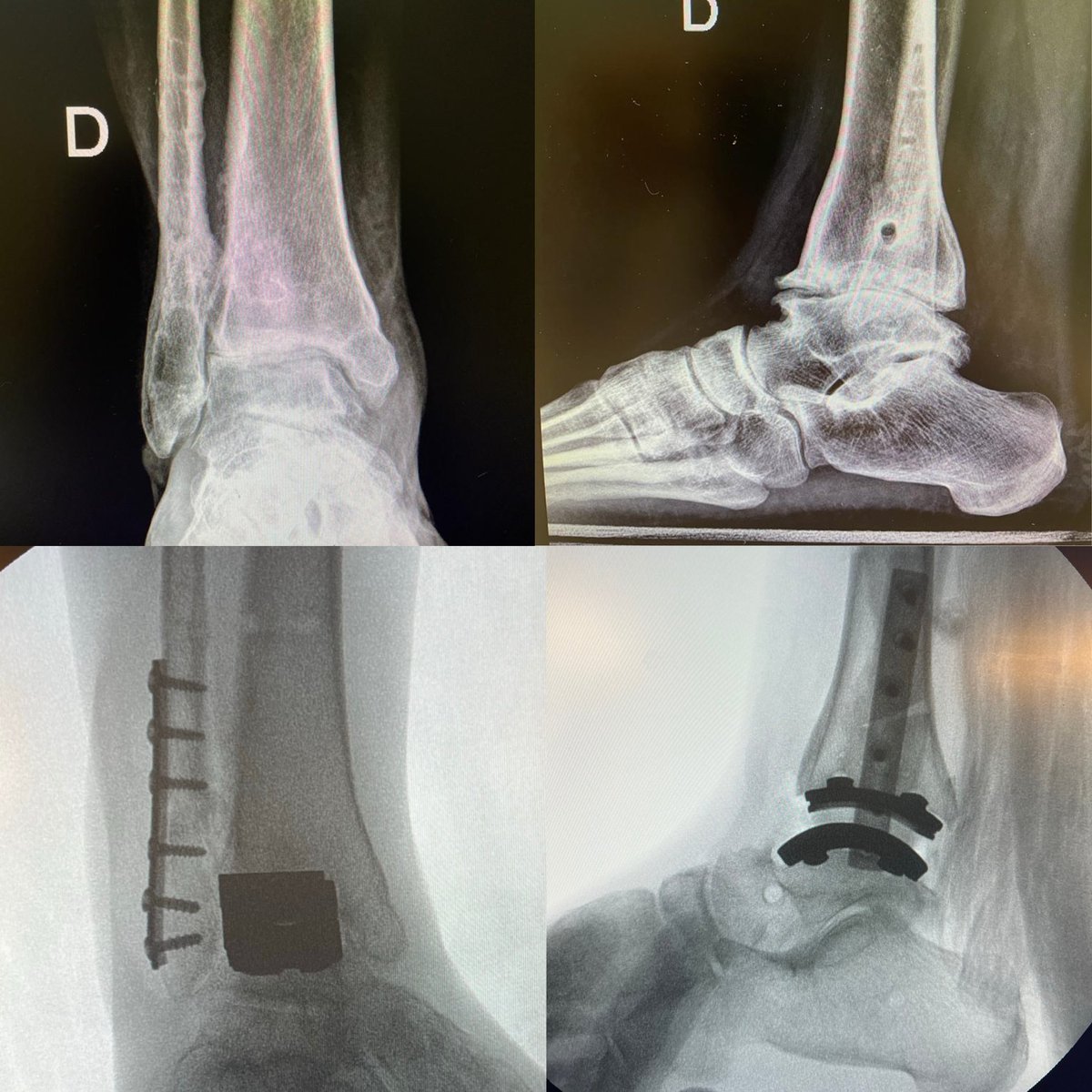 GonzaloBastias's tweet photo. Total Ankle Arthroplasty at the end of the world! We are very happy to had assisted in the first (and southernmost!) TM ankle replacement at @HCMagallanes !

#patagonia #puntaarenas #magallanes #chile #totalanklereplacement #anklearthritis #orthotwitter #arthroplasty #orthopedics https://t.co/4Ore0ofAmU