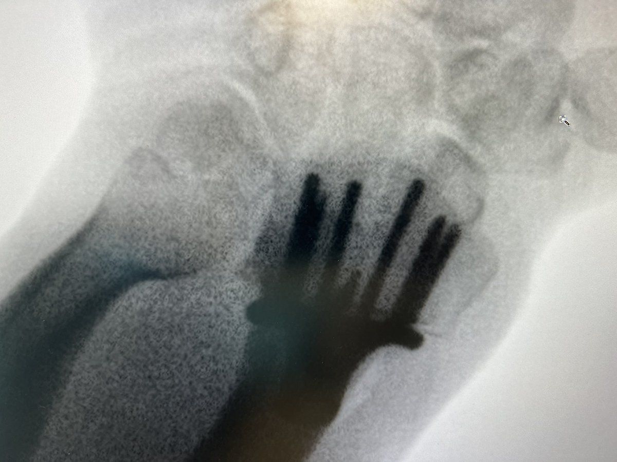 DrBhavinJadav's tweet photo. Love the dorsal tangential view with wrist extension. AKA the ‘DRUJ’ view. 
Shows the dorsal profile (to check screws are not too long) and also shows the DRUJ congruity, makes sure there is no step (or screw) in the Sigmoid notch. https://t.co/FKlYhQ4fnd