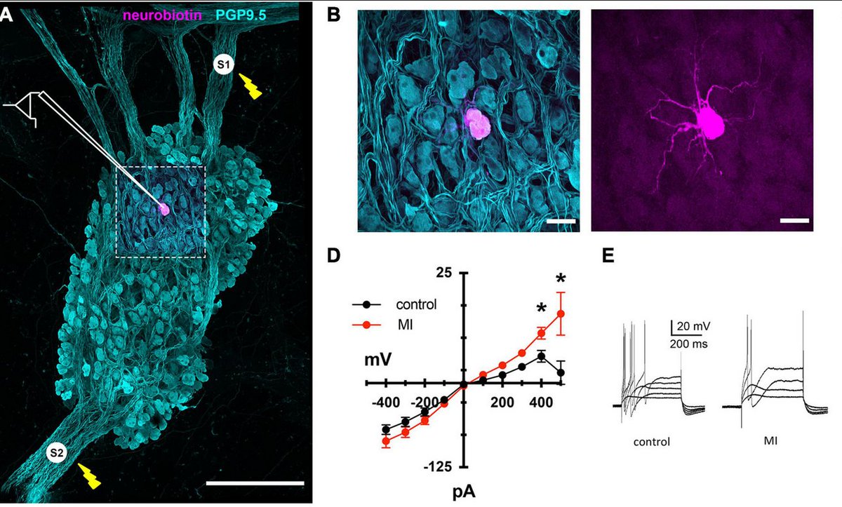shivkumarmd's tweet photo. Impact of MI on cardiac neurons, new paper by my colleague Dr. John Tompkins
Vagally-mediated heart block after myocardial infarction associated with plasticity of epicardial neurons controlling the atrioventricular node https://t.co/qBtWdoRdMS @utedrow @clancyatheart https://t.co/lpJ5CiQBkx