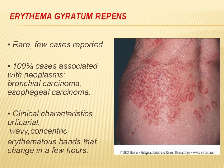 Sthanu on X: "Erythema gyratum repens 👇 typically associated with an  underlying malignant condition ♦️ lung cancer, esophageal and breast  cancers ♦️ may regress with treatment of the cancer  https://t.co/0cP4wzXbcH" / X