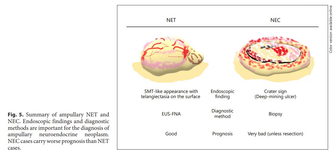 GastroKarger's tweet photo. Ampullary Neuroendocrine Neoplasm: Clinicopathological Characteristics and Novel Endoscopic Entity
โ Kazuhide Matsumoto
๐ https://t.co/HGgQe3AGls
#DigDis #AmpullaryNEN #Pancreas #EndoscopicPapillectomy https://t.co/tybtwklhE4