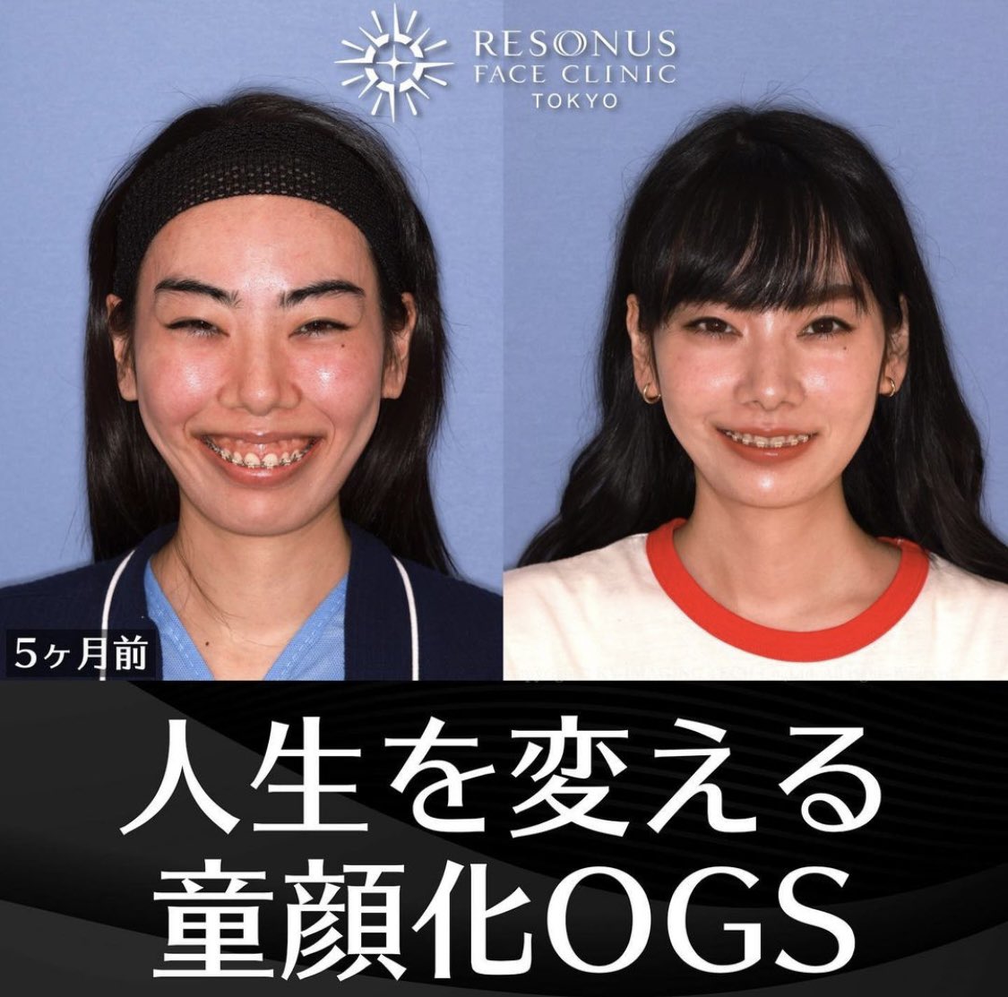 pipi_pipi_chan_'s tweet photo. これぞ整形の真骨頂 https://t.co/uLVpRAZUVM