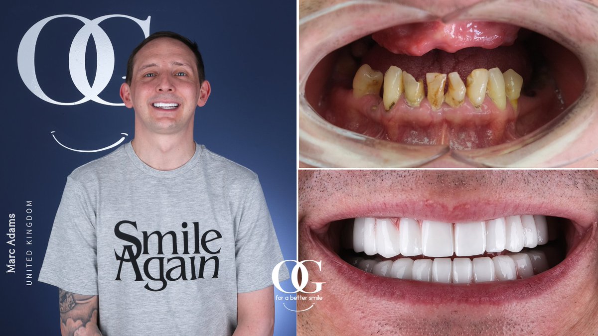 dtozanguner's tweet photo. As Mark said: "It's time to Smile Again!" ๐คฉ๐ฅณ
Contact us for more information about Full Mouth OG Smile!
๐+491783233900
#ogsmile #dentist #beforeandafter #dentalclinic #dentalimplants #zirconiumcrowns #smilemakeover #hollywoodsmile #smiledesign https://t.co/R8QEKZkKiL
