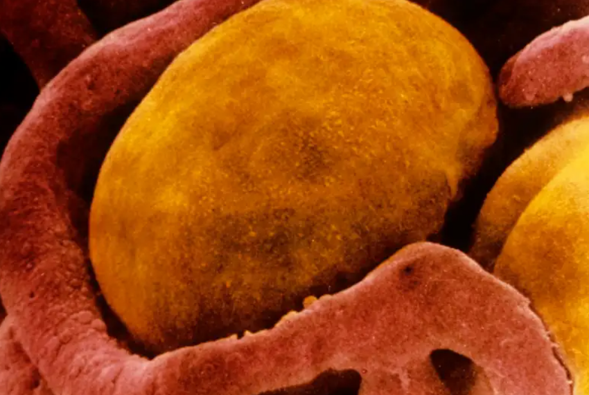 Oprirea dezvoltării unor tumori cu ajutorul criogenizării!

tehnostiri.ro/index.php/2022…