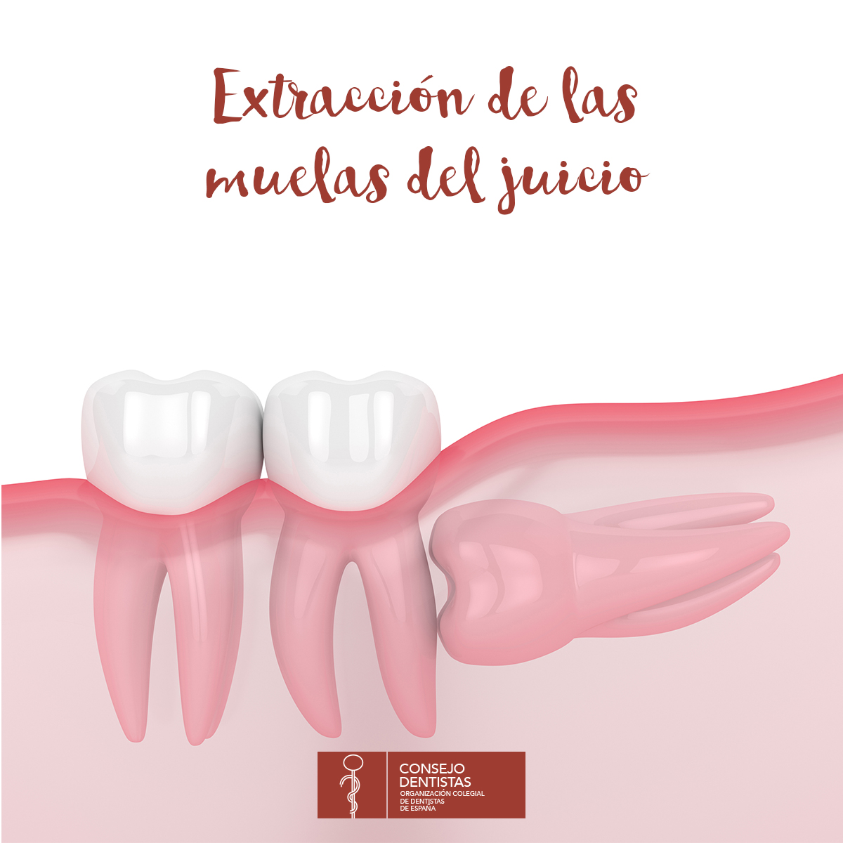 Las muelas del juicio, también conocidas como cordales, son los últimos dientes en erupcionar, habitualmente entre los 18 y 24 años. Su extracción es una de las cirugías más frecuentes dentro de la Odontología.
(👇🏻)