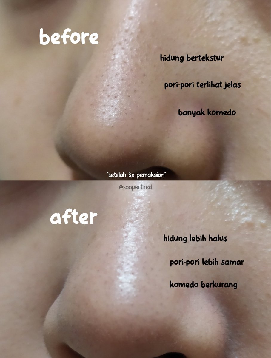 soopertired's tweet photo. This is why masker ini viral bgt di Tiktok, karena emg seajaib itu! Buat kalian yang hidungnya gradakan karena bnyak komedo, this is highly recommended! 

💫 𝑨𝒛𝒓𝒊𝒏𝒂 𝑷𝒖𝒓𝒆 𝑪𝒉𝒂𝒓𝒄𝒐𝒂𝒍 𝑴𝒖𝒅 𝑴𝒂𝒔𝒌 💫

#racuninskincare #azrinabeauty #azrinacharcoalmask https://t.co/tkfPkQF6PR