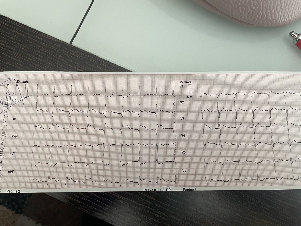 85_cruz's tweet photo. Dolor toràcic + vegetatisme; 30’ evolució. Pacient portador 6 stent.
#usvae #b417 #codiiam https://t.co/clxWfNCDMc