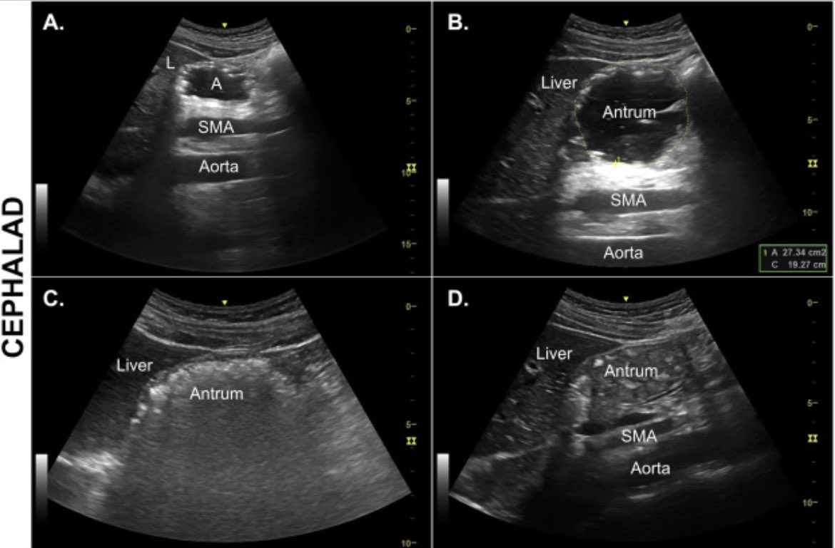 Gastric Ultrasound and state of fasting. 

Useful when fasting status is unknown / delayed gastric emptying !

Link to Article 🔗 bjaed.org/article/S2058-…

#POCUS #Gastricultrasound #FOAMus #anaesthesia #FOAMcc 

Review Article by @elboghdadly, Wojcikiewicz & @PerlasAnahi BJA 2019