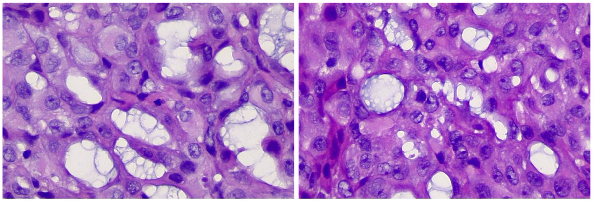 CPathig's tweet photo. 81-year-old male with multiple pleural based nodules measuring up to 2.1 cm. Diagnosis? #pathology  #pulmpath Answer: https://t.co/kwlQX1ZfBK https://t.co/vHV64ETTMv