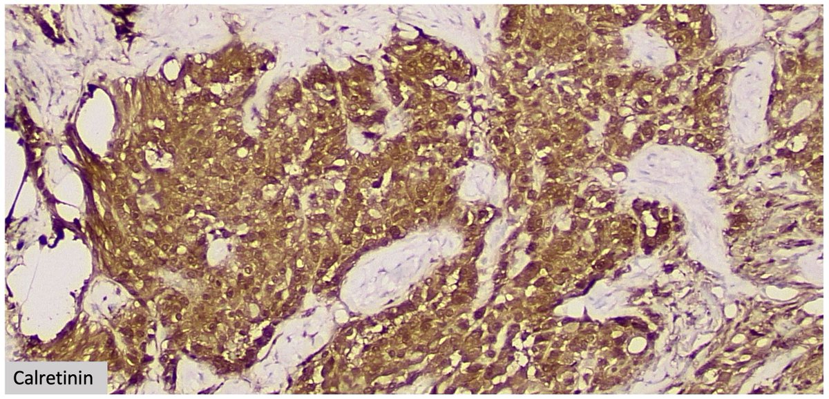 CPathig's tweet photo. 81-year-old male with multiple pleural based nodules measuring up to 2.1 cm. Diagnosis? #pathology  #pulmpath Answer: https://t.co/kwlQX1ZfBK https://t.co/vHV64ETTMv